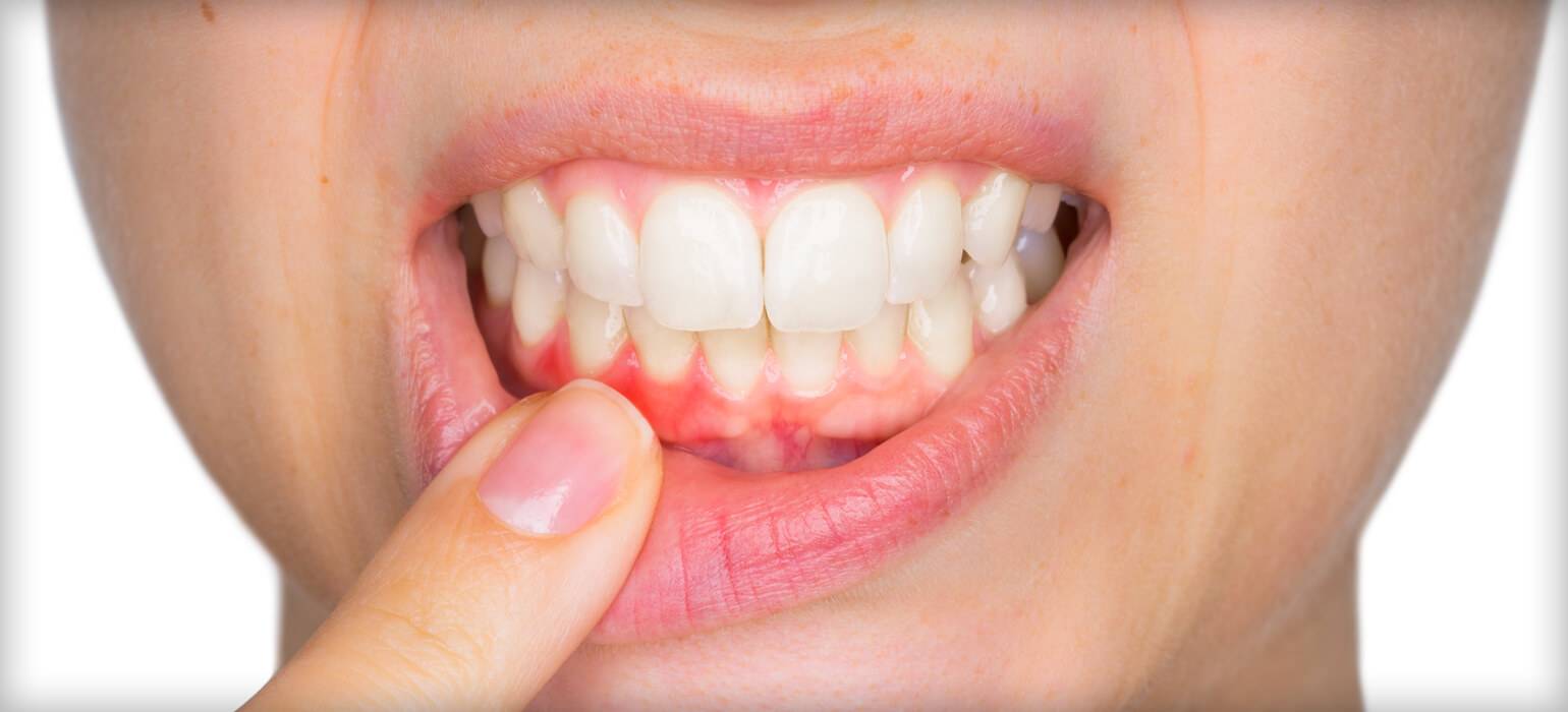 Ourservices Gumdisease Tiny exposed gums
