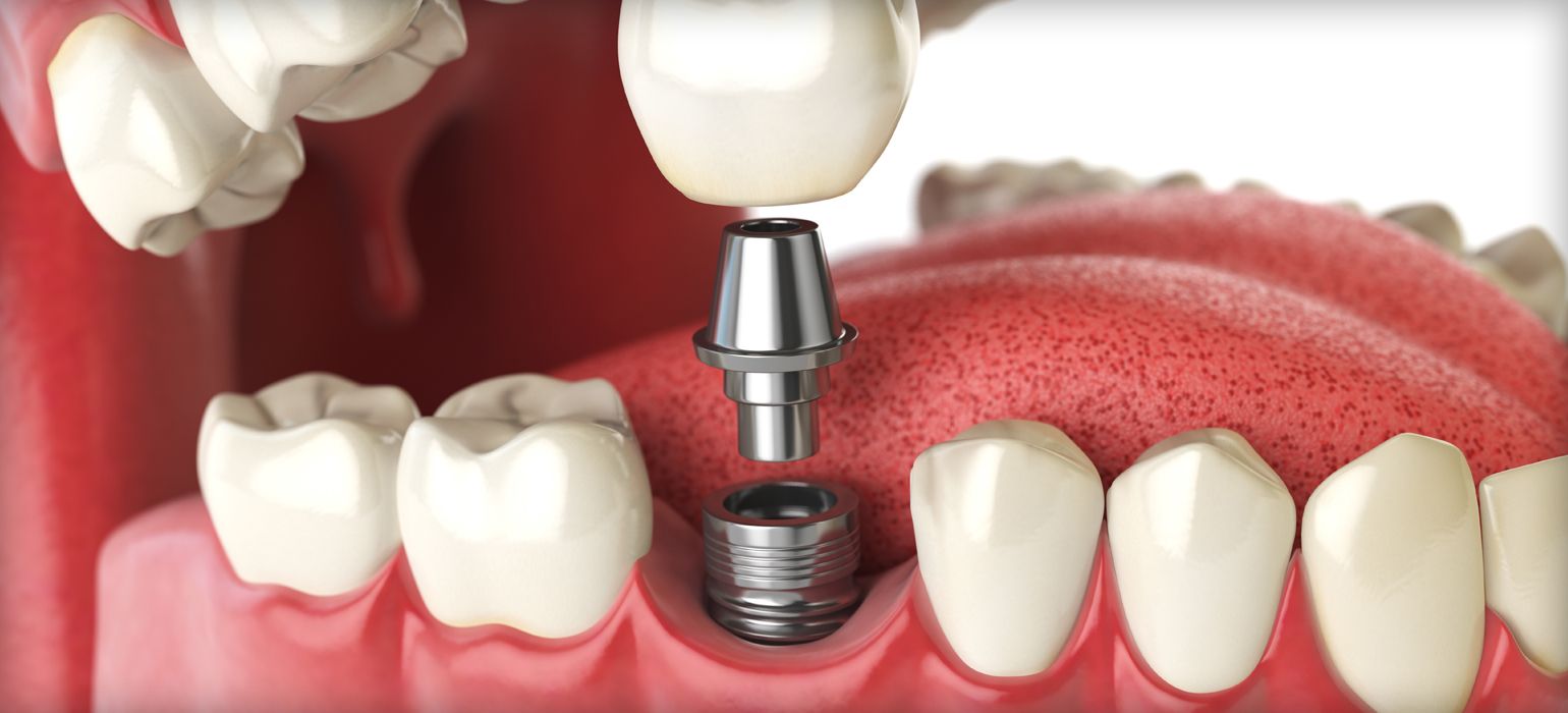 Ourservices Implants (1) tooth implant