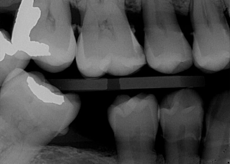 Overjet Xray Overjet Xray
